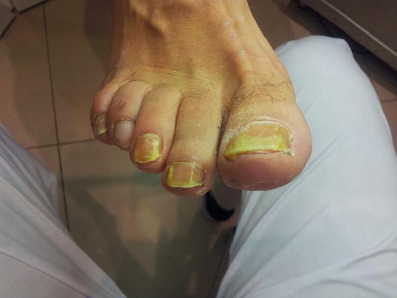 dzelteni kāju nagi ar sēnīti