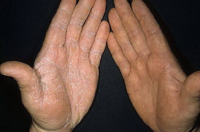 sēnītes simptomi uz roku ādas