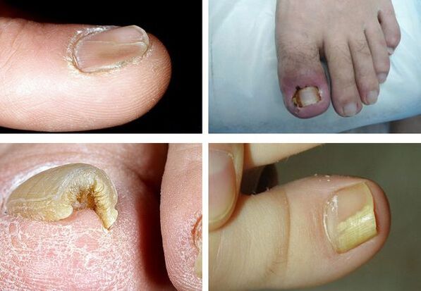 Onihikomozes simptomi uz kājām