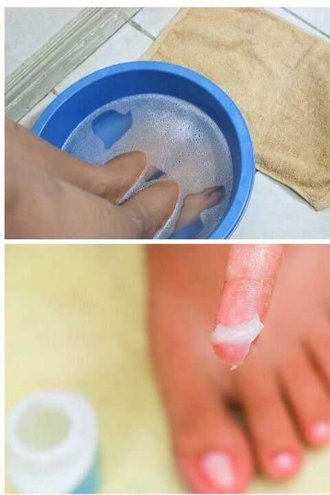 dabisko eļļu izmantošana kāju nagu sēnīšu ārstēšanā