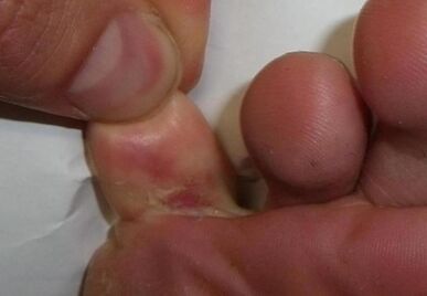 pirksta plaisa ir sēnīšu infekcijas rezultāts